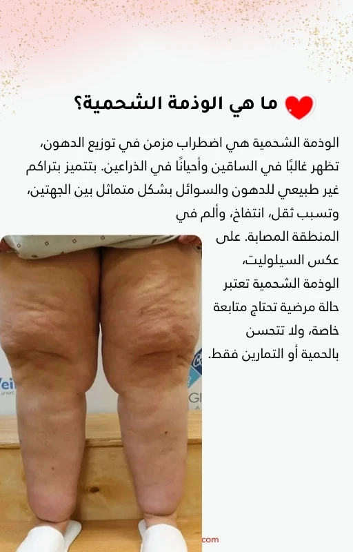 دليلك للتعرف على السيلوليت والوذمة الشحمية والتخلص منهما