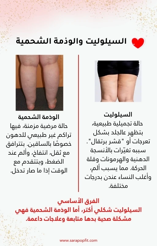 دليلك للتعرف على السيلوليت والوذمة الشحمية والتخلص منهما