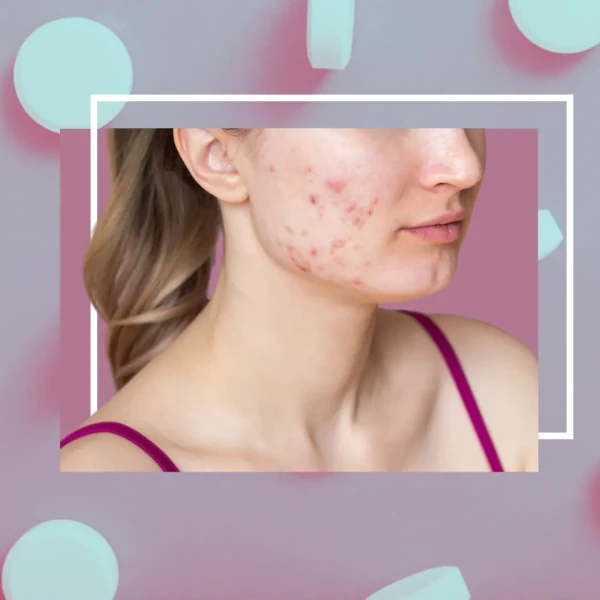 The Link between Acne Medicine and Nose Reduction