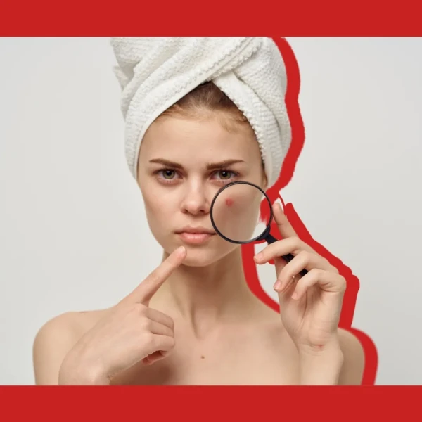Acne | Causes and Treatment